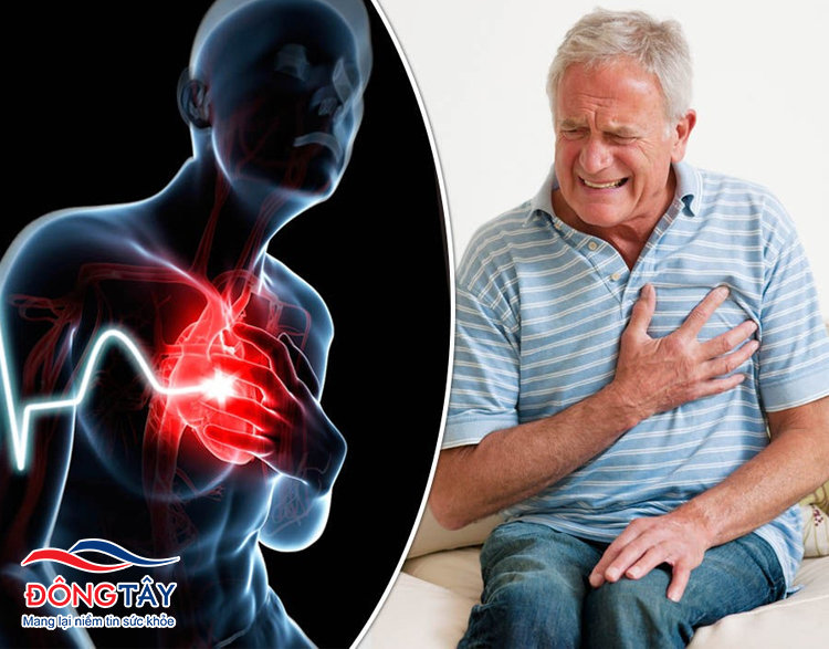 Điều trị hội chứng mạch vành cấp cần khẩn trương để giảm nguy cơ tử vong